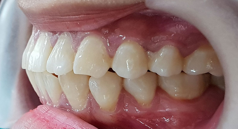 Phân biệt hô răng và hô hàm. cách nhận biết hô hàm hay hô răng