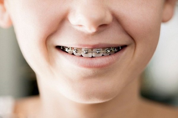 Sự khác nhau giữa niềng răng trẻ em và người lớn | niềng răng cho trẻ em giá bao nhiêu bao nhiêu