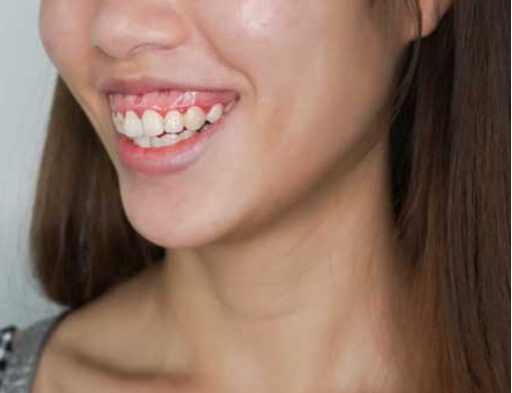 Tổng hợp Cách làm răng hết hô tại nhà & nha khoa Hiệu Quả Nhất