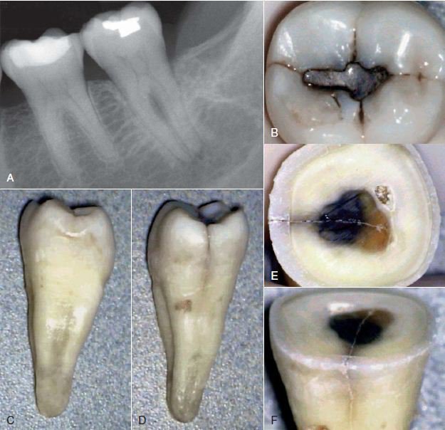 Nứt và gãy chân răng: Đặc điểm lâm sàng và phân loại | Niềng răng không thành công