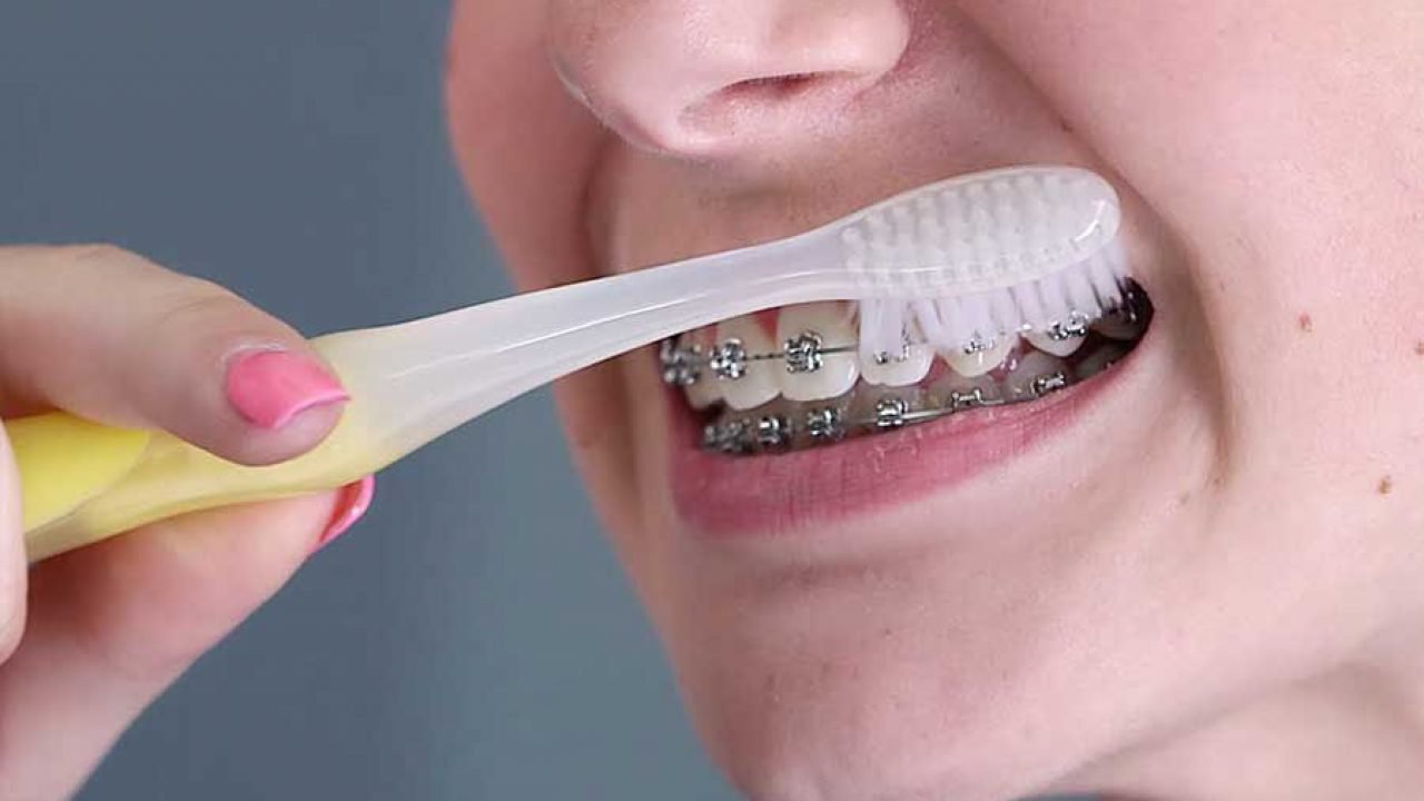 Cách đánh răng đúng cách khi niềng răng | Vinmec