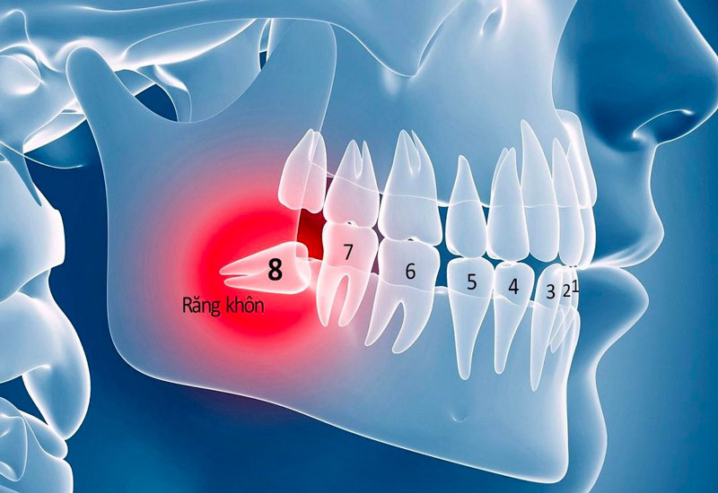 Răng khôn thường mọc ở tuổi trưởng thành.