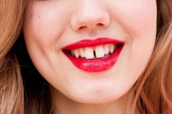 Cách khắc phục răng cửa bị thưa hiệu quả nhất?
