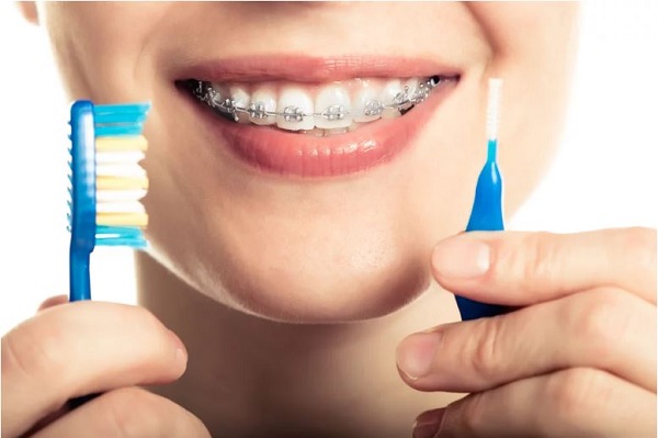 5 cách vệ sinh đúng cách khi niềng răng - Niềng răng sau sinh có được không