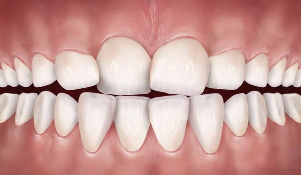 Khớp cắn đối đầu là gì? Niềng răng có khắc phục được không? | Zenyum VN