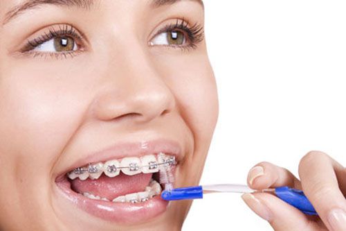 Niềng răng hô với CN 3D Speed giải pháp chữa trị răng hô (vẩu) 1