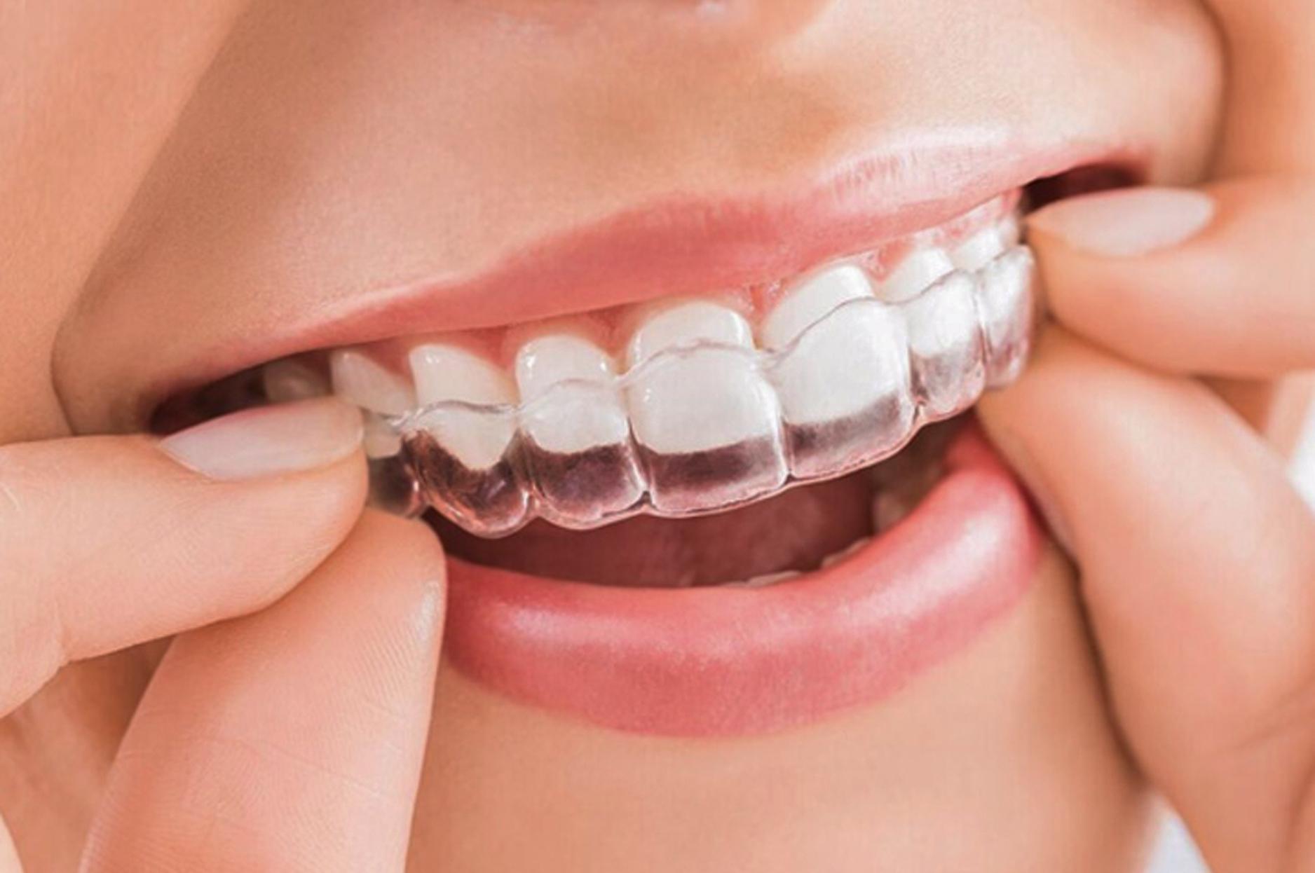 Niềng răng trong suốt INVISALIGN là gì?