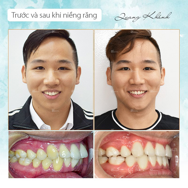 Trước và sau khi niềng răng quá khác biệt, thật khó tin đó là cùng một người