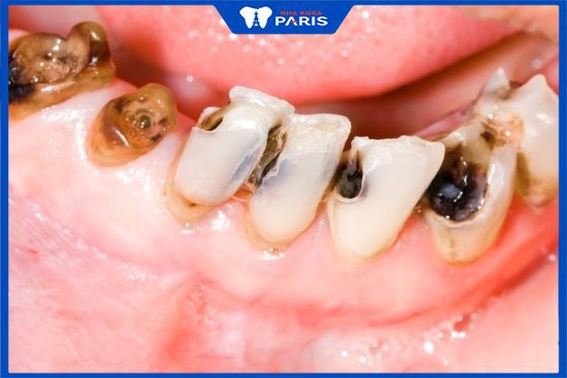 Top 9 bệnh về răng miệng thường gặp nhất mà bạn không thể bỏ qua - niềng răng khớp cắn ngược bao lâu