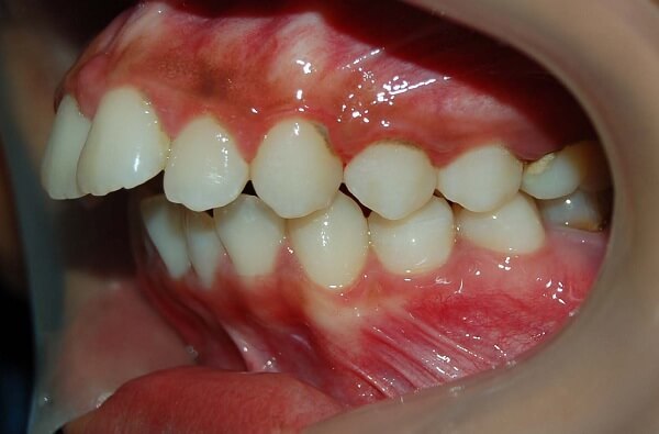 Răng hô là gì? Cách chữa và chi phí chi tiết nhất - cách nhận biết hô hàm hay hô răng