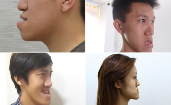 miệng móm xấu hay đẹp