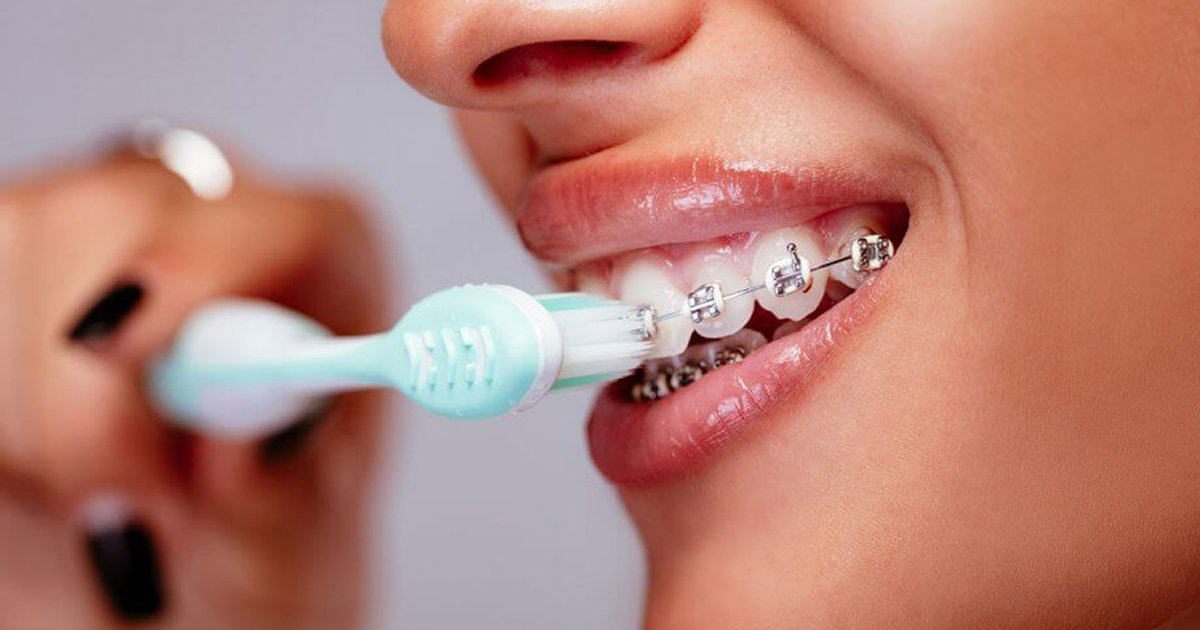 Cách đánh răng cho người niềng răng: Làm thế nào cho đúng?
