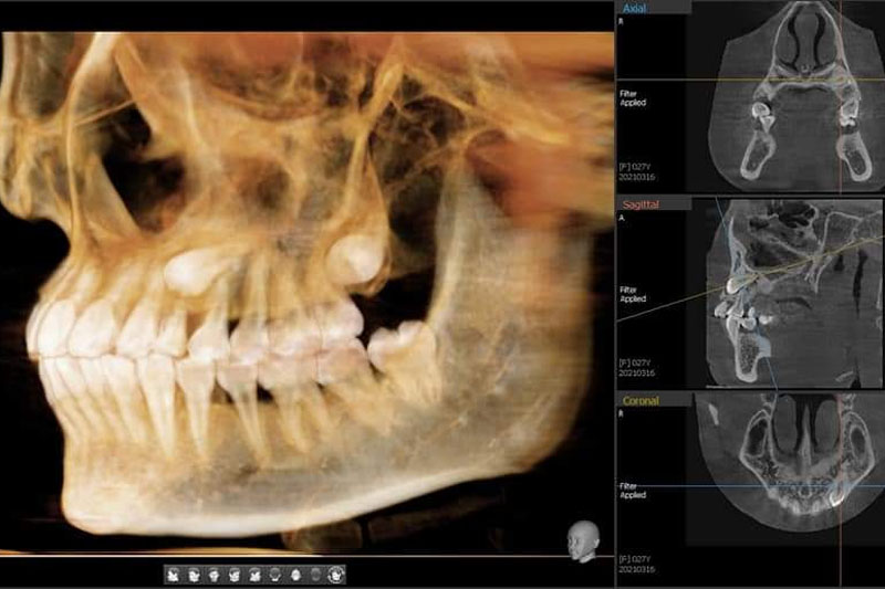 Hô hàm và hô răng: Bạn đã biết cách phân biệt chưa? cách nhận biết hô hàm hay hô răng