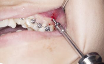 Cắm minivis bị viêm