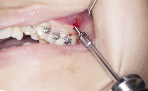 Cắm minivis bị viêm