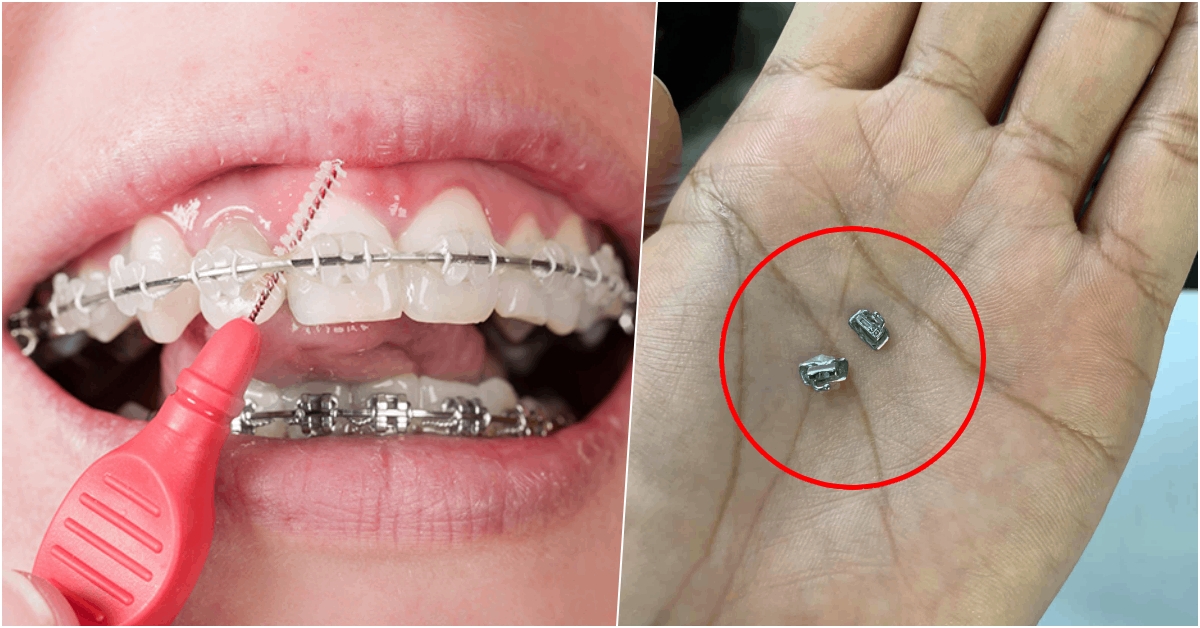 Nhiều người sắp bị hỏng niềng răng do nha khoa đóng cửa - nuốt mắc cài niềng răng