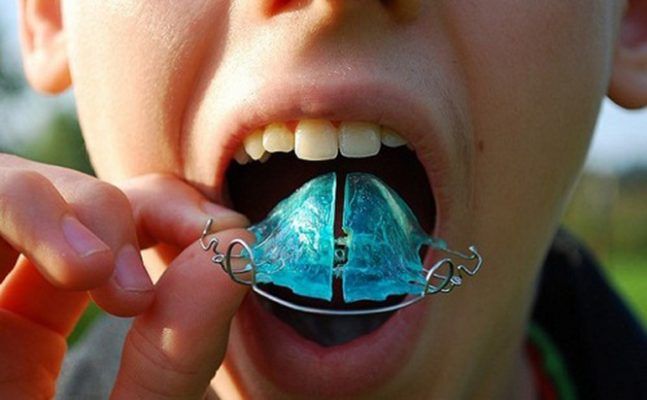 Các Loại Niềng Răng Bằng Khí Cụ Tháo Lắp Phổ Biến Nhất – cách làm răng bớt hô