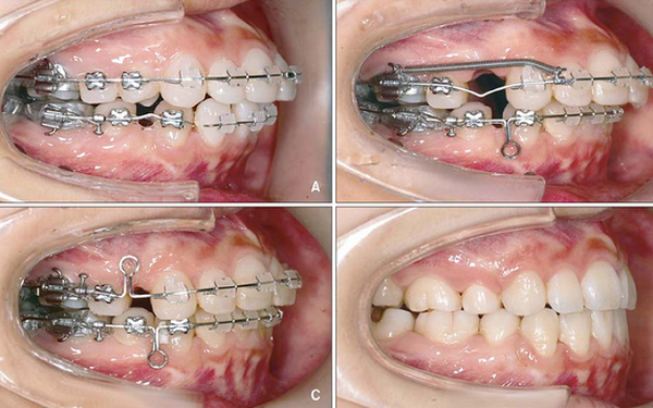 Nên nền răng khi nào, niềng răng mất bao lâu? Tháo niềng răng có đau không