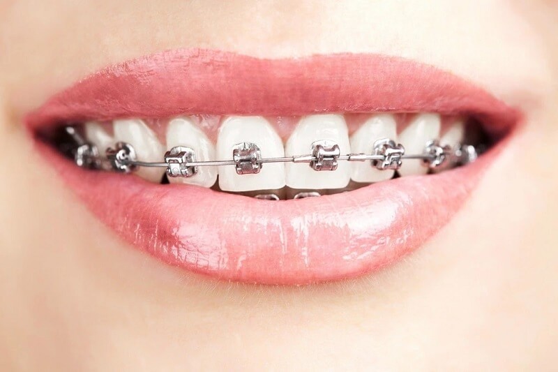 Liệu có nên tẩy trắng răng trước khi niềng răng? Niềng răng sau sinh có được không