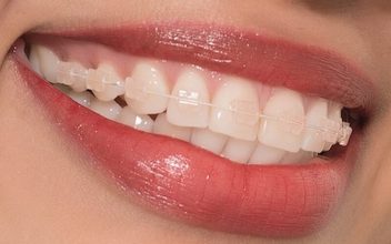 28 tuổi niềng răng hô có hiệu quả không?