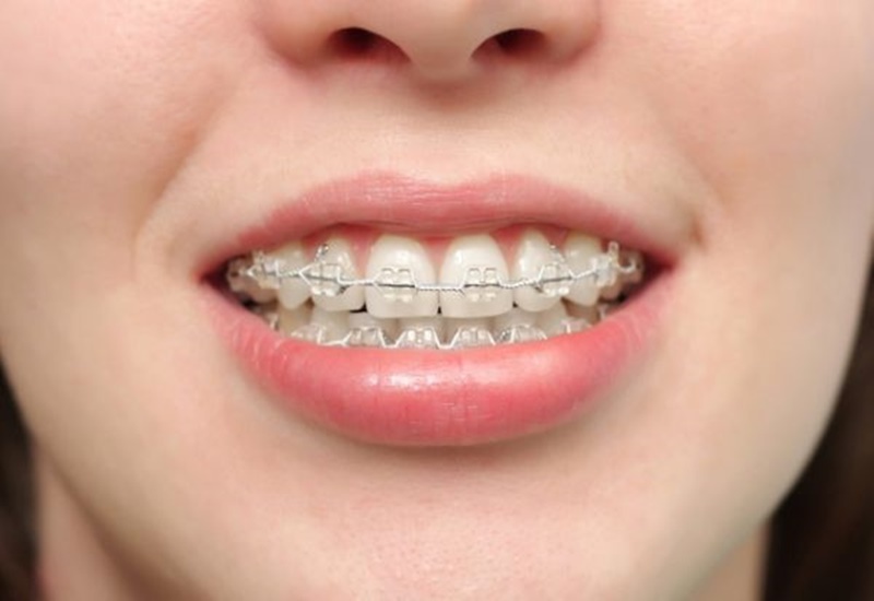 Niềng răng nên được thực hiện đúng quy trình để đạt được hiệu quả thẩm mỹ tốt nhất