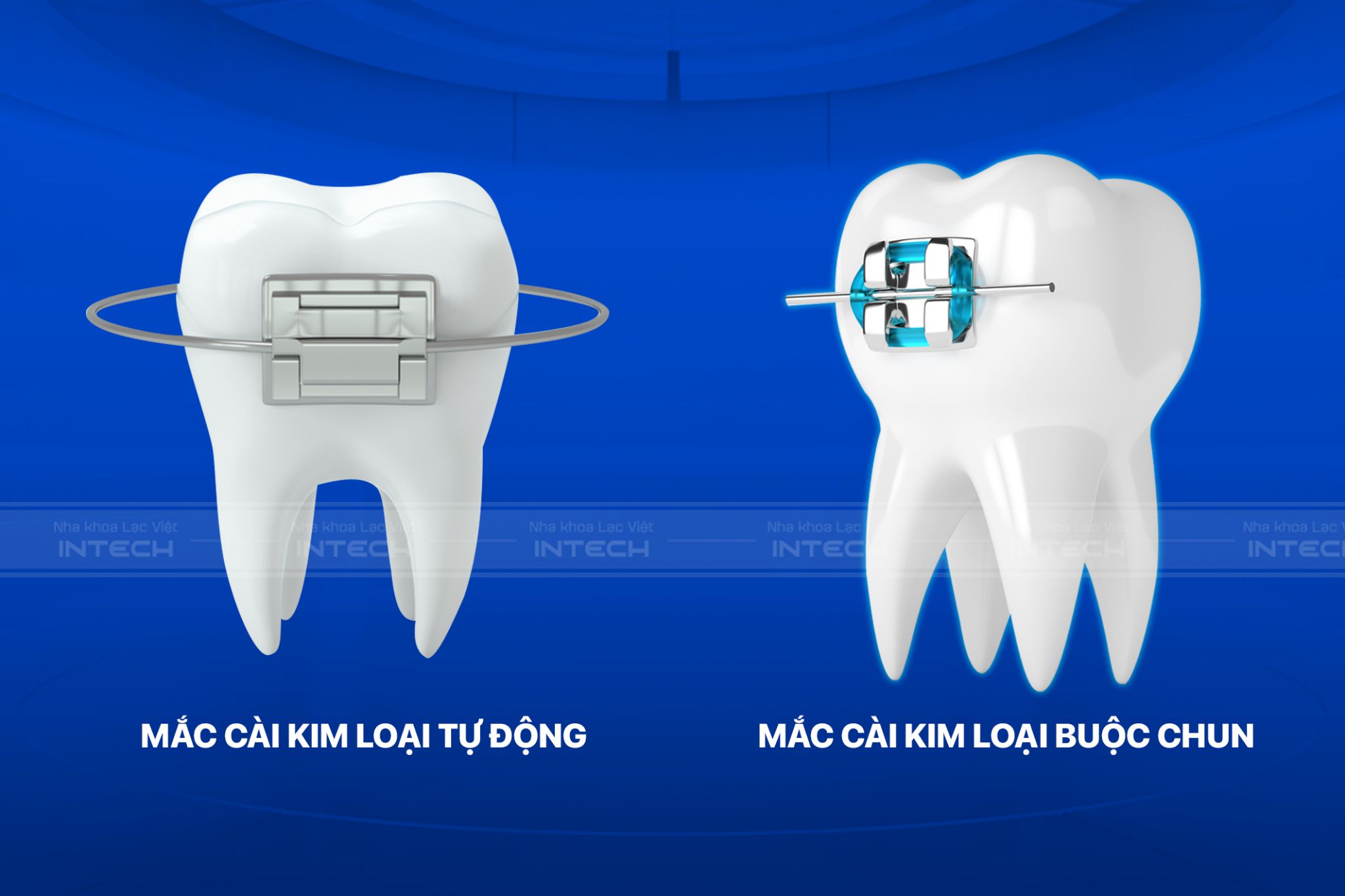 Mắc cài tự động và mắc cài buộc chun có cấu tạo và chức năng gì? giá niềng răng