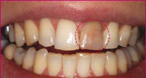 Những dấu hiệu cho thấy răng bạn đang bị chết tủy? Niềng răng không thành công