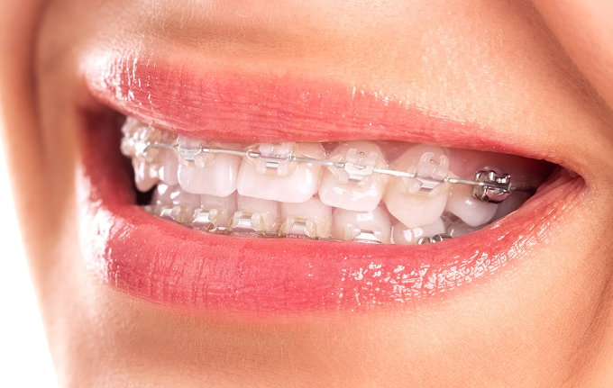 Hỏi: Quá trình thực hiện niềng răng có đau hay không? ưu điểm vượt trội của niềng răng mắc cài sứ