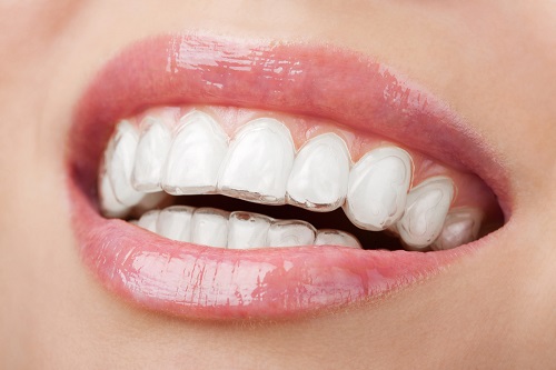 Niềng Răng Không Mắc Cài