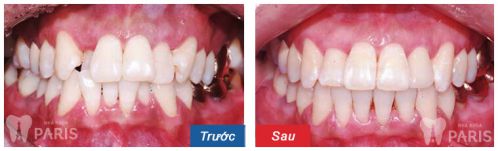 Niềng răng hô với CN 3D Speed giải pháp chữa trị răng hô (vẩu) 2