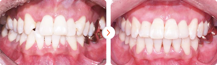 Trước và sau khi niềng răng có kết quả như thế nào? 1