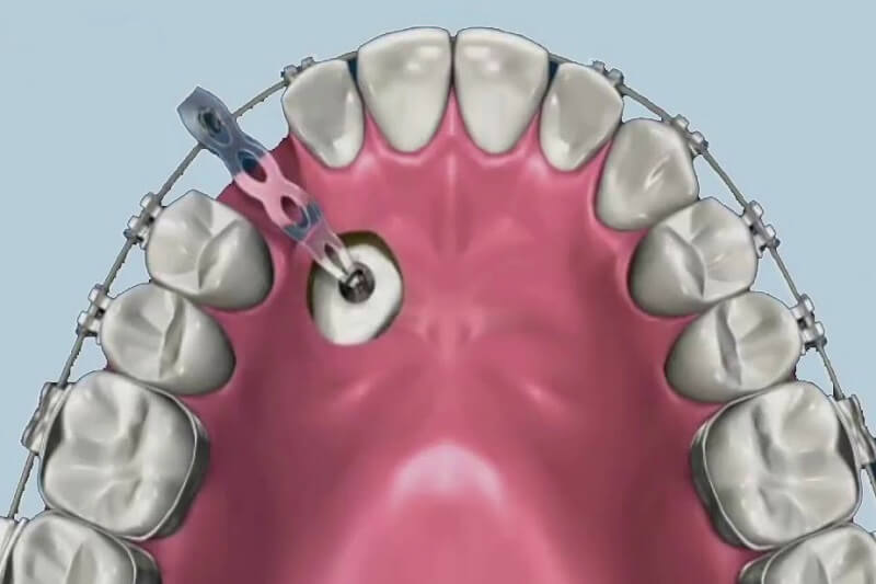 Răng nanh mọc ngầm trong xương hàm khắc phục như thế nào? giá niềng răng nanh mọc ngầm