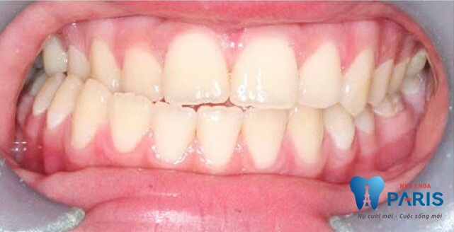 Khớp cắn chéo - Cách nhận biết và điều trị triệt để cho hàm răng đều