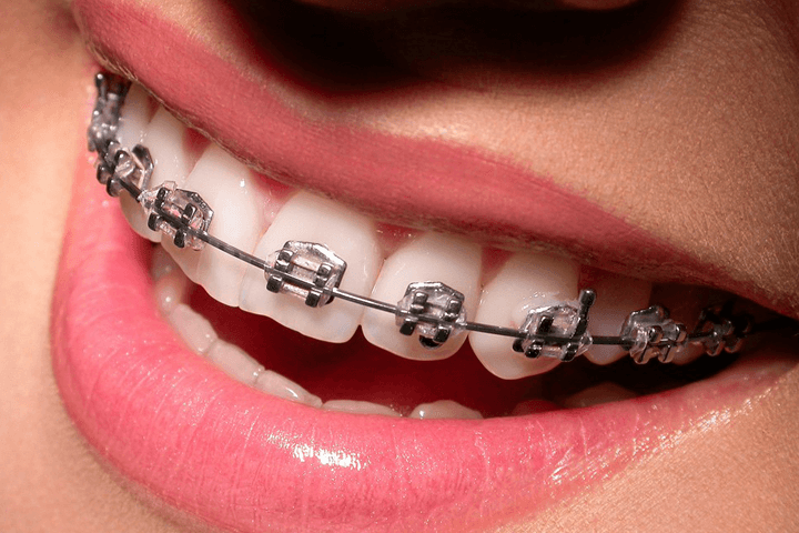 QUY TRÌNH NIỀNG RĂNG TẠI NHA KHOA OMEGA DENTAL - cách làm răng bớt hô