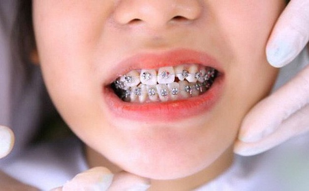 Nẹp răng cho trẻ em và những vấn đề cần lưu ý | Bé mọc răng vĩnh viễn bị thưa cần điều trị thế nào?