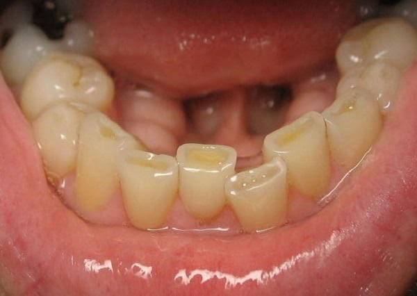 Nghiến răng ban đêm - bài thuốc Đông y chữa nghiến răng khi ngủ