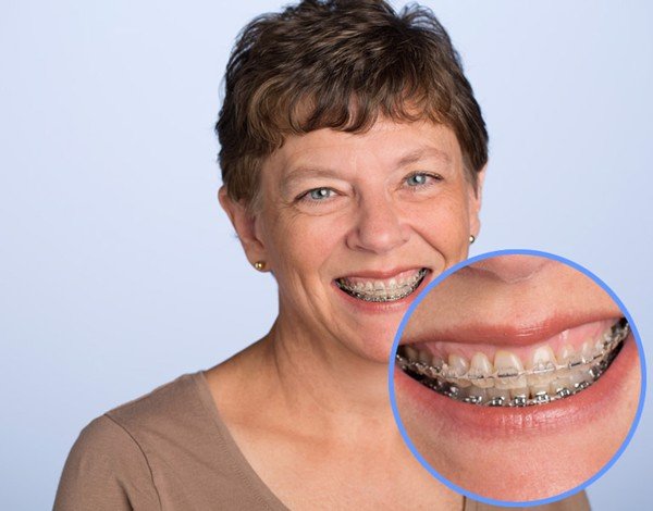 Người lớn từ 17-35 tuổi có niềng răng được không? – Nha khoa Home