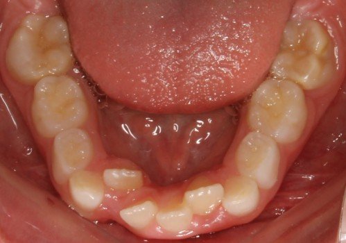 Răng mọc lệch và cách khắc phụ hiệu quả cao - Răng sữa chưa rụng răng vĩnh viễn đã mọc