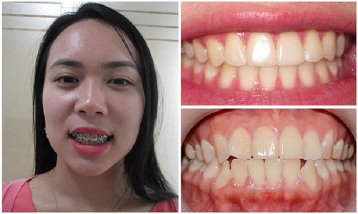Niềng răng một hàm có được không, có mang lại hiệu quả không? cách làm răng cửa nhỏ lại tại nhà