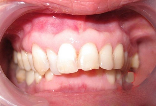 Nhận biết 2 dạng răng hô: Hô hàm và hô răng - cách nhận biết hô hàm hay hô răng