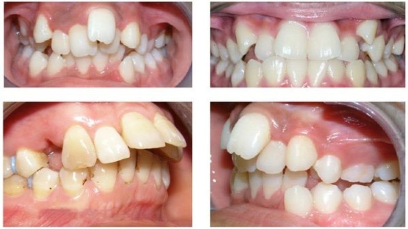 Răng hô là gì? Những phương pháp giúp xử lý răng bị hô hiệu quả