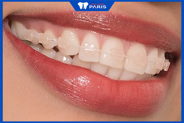Niềng răng 1 hàm giá bao nhiêu tiền?