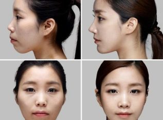 Niềng răng có làm mũi cao lên hay không