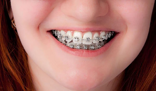 Giá niềng răng 2020 bao nhiêu tiền? răng 9630 là gì