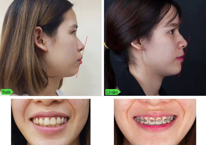 Giải pháp cho răng vổ, hô hàm trên và răng hô nhẹ - cách làm răng bớt hô