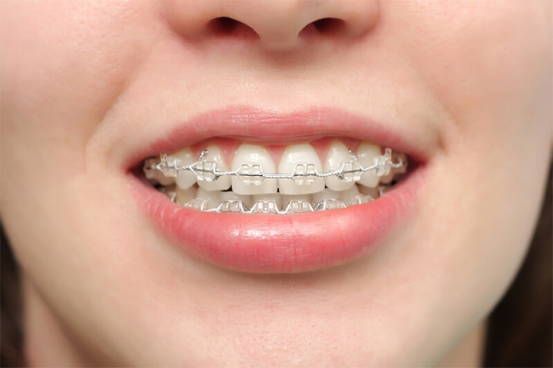 Muốn niềng răng hô hiệu quả lâu dài bạn không thể bỏ qua 8 điều này - răng cửa bị nghiêng