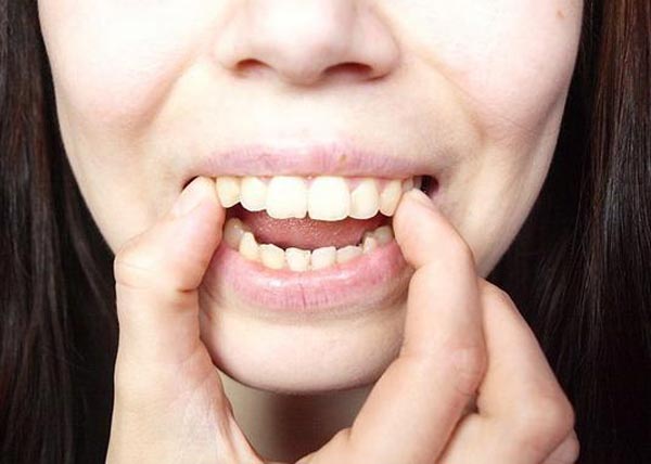 Làm răng bớt hô tại nhà có hiệu quả không? cách làm răng bớt hô