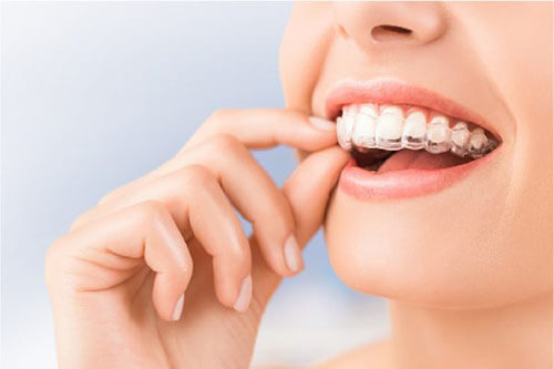 Niềng răng Invisalign và toàn tập những câu hỏi thường gặp - Răng quặp vào trong