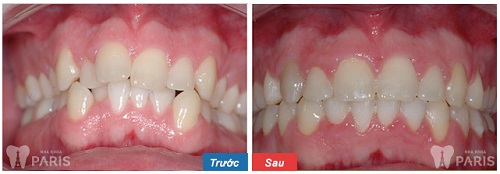 niềng răng không mắc cài - Thẩm mỹ toàn diện, nhanh hơn tới 6 tháng 