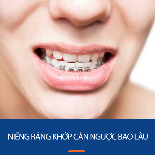 niềng răng khớp cắn ngược bao lâu